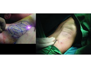 Przed i po: laserowe leczenie nadpotliwości 