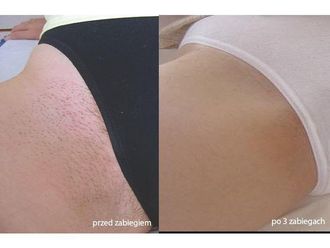 Depilacja laserowa przed i po - 690961