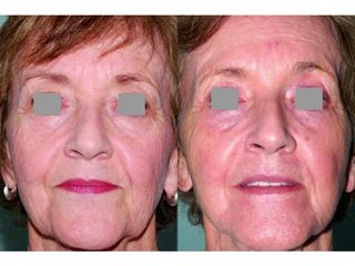 Przed i po: anti-aging