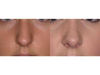 Przed i po - korekta nosa