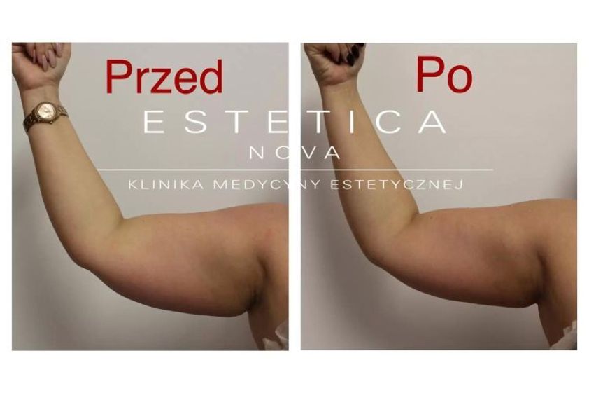 Liposukcja nieinwazyjna przed i po - 687519