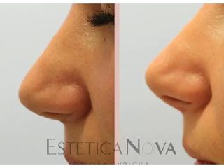 Korekta nosa kwasem hialuronowym - przed i po