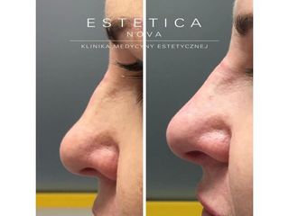 Korekta nosa kwasem hialuronowym - przed i po