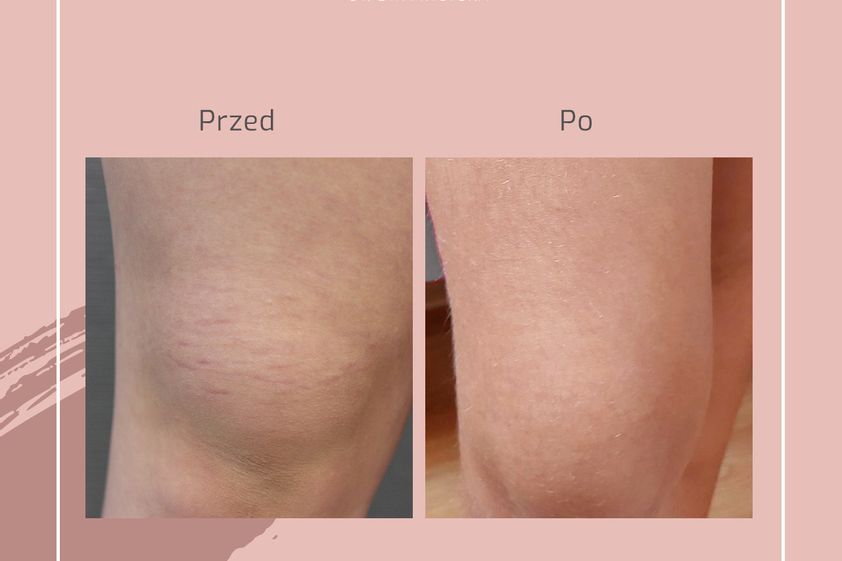 Usuwanie rozstępów przed i po - 740730