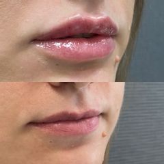 korekta ust - efekt po 3 zabiegu