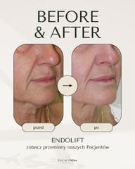 Endolift Estetica Nova Dr Ewa Rybicka