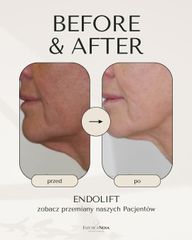 Endolift Estetica Nova Dr Ewa Rybicka