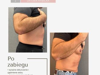 Lifting bez skalpela przed i po - 877804