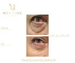 Blefaroplastyka - Dr Anna Ptasiński