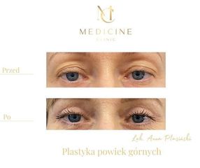 Blefaroplastyka - Dr Anna Ptasiński