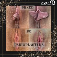 Labioplastyka - Dr n. med. Karolina Waleśkiewicz-Ogórek