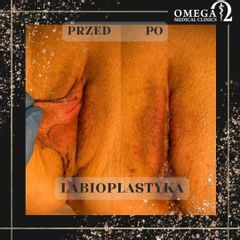 Labioplastyka - Dr n. med. Karolina Waleśkiewicz-Ogórek