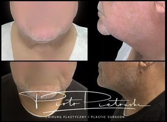lift podbródka z liposukcją szyi