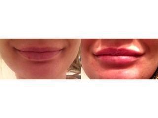 Przed i po - modelowanie ust kwasem hialuronowym