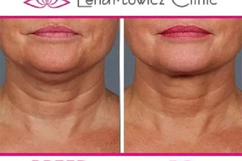 Lipoliza iniekcyjna przed i po - 655119