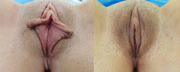 Labioplastyka z hoodoplastyką - Intima Clinic