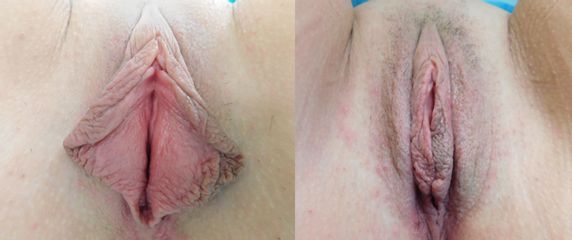 Labioplastyka z hoodoplastyką - Intima Clinic