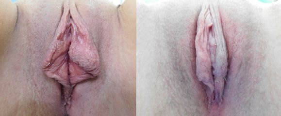 Labioplastyka - Intima Clinic