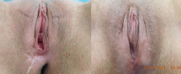 Perineoplastyka - Intima Clinic