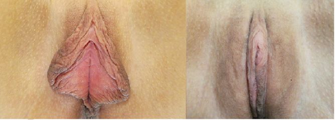 Labioplastyka - Intima Clinic