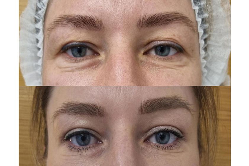 Blefaroplastyka przed i po - 826589