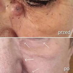 usuwanie zmian skórnych - dr n. med. Karolina Wójcicka
