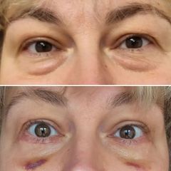 Blefaroplastyka - dr n. med. Karolina Wójcicka