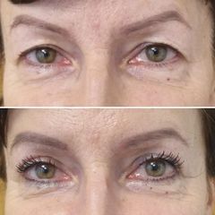 Blefaroplastyka - dr n. med. Karolina Wójcicka