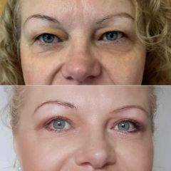 Blefaroplastyka - dr n. med. Karolina Wójcicka