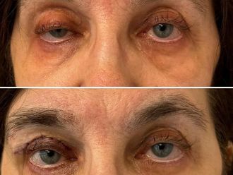 Blefaroplastyka przed i po - 868960