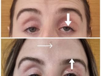 Blefaroplastyka przed i po - 870216