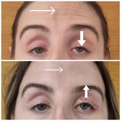 Blefaroplastyka - dr n. med. Karolina Wójcicka