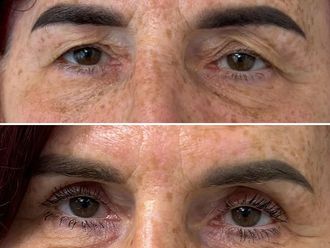 Blefaroplastyka przed i po - 870688