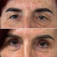 Blefaroplastyka - dr n. med. Karolina Wójcicka