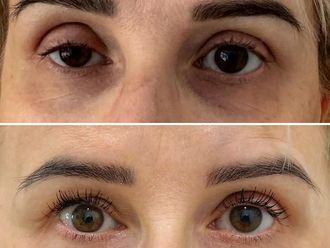 Blefaroplastyka przed i po - 871710