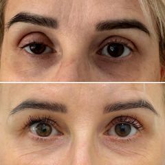 Blefaroplastyka - dr n. med. Karolina Wójcicka