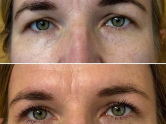 Blefaroplastyka przed i po - 872035