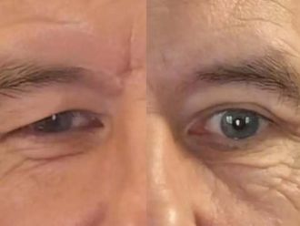 Blefaroplastyka przed i po - 872340