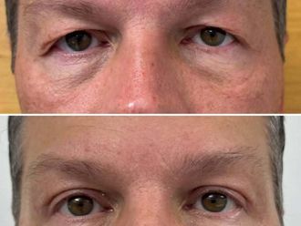 Blefaroplastyka przed i po - 872341