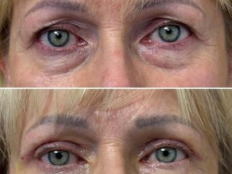 Blefaroplastyka przed i po - 872774