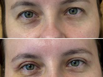 Blefaroplastyka przed i po - 872960