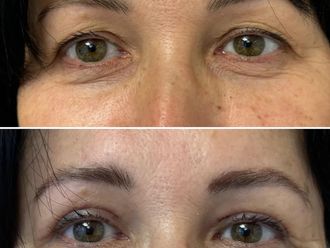 Blefaroplastyka przed i po - 872961