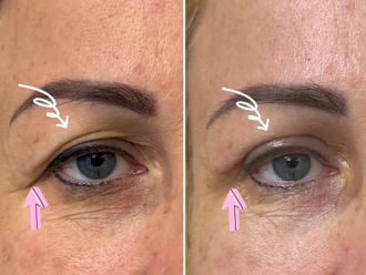 Blefaroplastyka przed i po - 872962