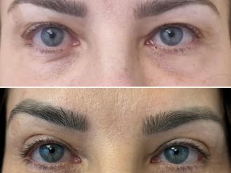 Blefaroplastyka przed i po - 873264