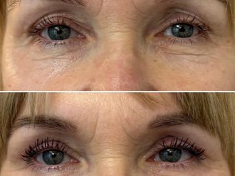 Blefaroplastyka przed i po - 873265