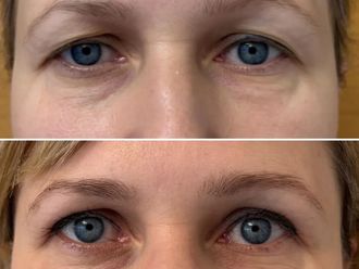 Blefaroplastyka przed i po - 874362