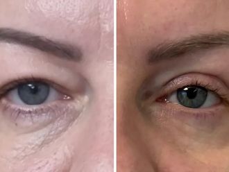 Blefaroplastyka przed i po - 874363