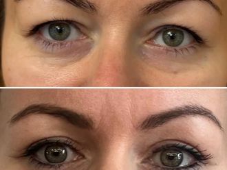 Blefaroplastyka przed i po - 876150
