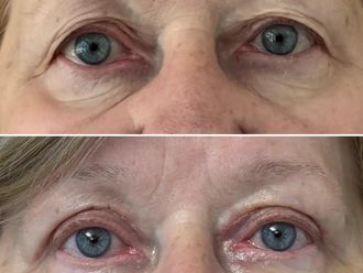 Blefaroplastyka przed i po - 876151