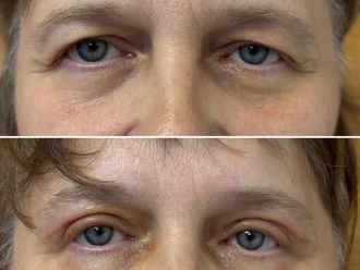 Blefaroplastyka przed i po - 876153